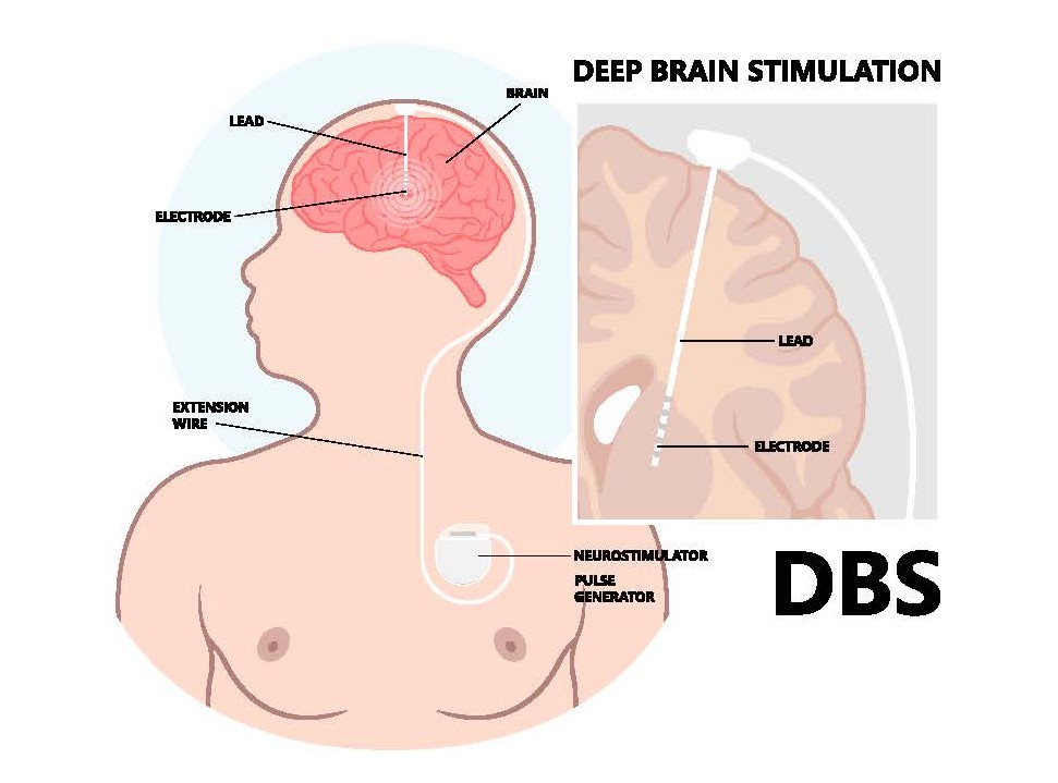 Stimulation cérébrale profonde en cas de tremblement essentiel ...