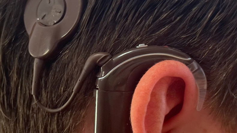 Cochleair implantaat_plaatsing