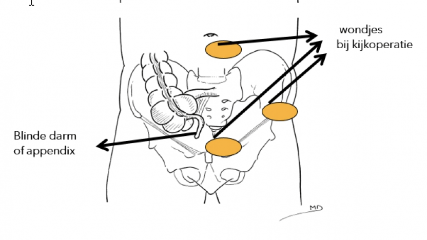Appendectomie